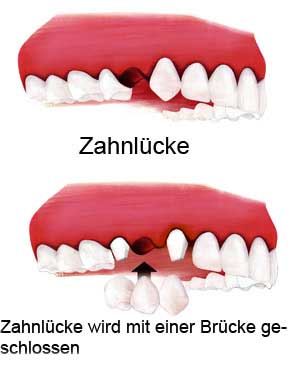 Abb. Zahnlücke wird mit einer Brücke geschlossen